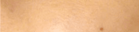 과색소침착증