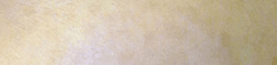과색소침착증